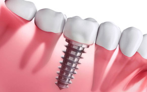IMPLANTS AND EXTRACTIONS